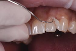 Figure 7: Final restoration try-in Figure 7: Final restoration try-in