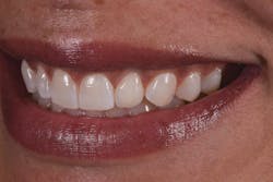 Figure 8: Final esthetic outcome using feldspathic porcelain veneer on No. 10 Figure 8: Final esthetic outcome using feldspathic porcelain veneer on No. 10