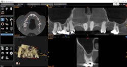 Figure 1: Using the CS 9300 imaging system, multiple views are available with an extensive tools menu. Figure 1: Using the CS 9300 imaging system, multiple views are available with an extensive tools menu.