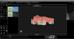Figure 2: Utilizing the CS 3600 intraoral scanner, an impression scan of the maxilla is highlighted.