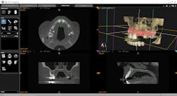 Figure 3: With integrative software, the CS 9300 imaging system merges the DICOM and STL files. Figure 3: With integrative software, the CS 9300 imaging system merges the DICOM and STL files.