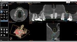 Figure 4: Potential grafting and implant placement sites are analyzed utilizing a robust software package that includes an extensive implant library.