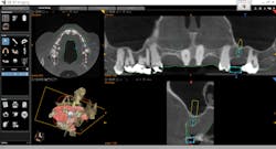 Figure 4: Potential grafting and implant placement sites are analyzed utilizing a robust software package that includes an extensive implant library. Figure 4: Potential grafting and implant placement sites are analyzed utilizing a robust software package that includes an extensive implant library.