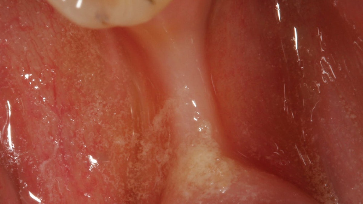 Bone Grafting After Tooth Removal Why When And What To Use Dental Economics Bone Grafting After Tooth Removal Why When And What To Use Dental Economics