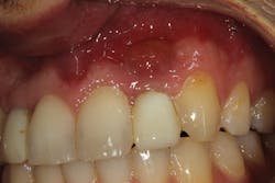 Figure 3: Abscess at the apex of implant No. 10 placed two years ago. The tooth was removed and the site was not preserved with graft material. The implant was placed six months after tooth removal.