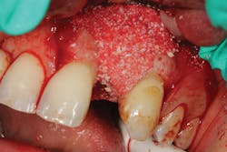 Figure 5: Buccal bone of implant was augmented with Geistlich Bio-Oss Collagen to save the implant from explantation. Figure 5: Buccal bone of implant was augmented with Geistlich Bio-Oss Collagen to save the implant from explantation.