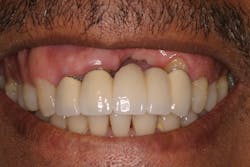 Figure 8: Soft- and hard-tissue loss on a tooth-borne bridge after extraction without grafting, resulting in an unesthetic restoration Figure 8: Soft- and hard-tissue loss on a tooth-borne bridge after extraction without grafting, resulting in an unesthetic restoration