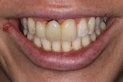 Figure 10: Collapse of hard and soft tissue under fixed bridge after tooth extraction without grafting. Photo courtesy of Michael J. Wei, DDS, FIADFE. Figure 10: Collapse of hard and soft tissue under fixed bridge after tooth extraction without grafting. Photo courtesy of Michael J. Wei, DDS, FIADFE.