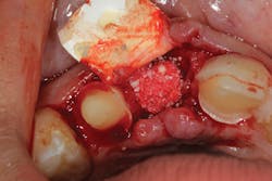 Figure 12: Pontic site development with Geistlich Bio-Oss Collagen and Geistlich Bio-Gide Figure 12: Pontic site development with Geistlich Bio-Oss Collagen and Geistlich Bio-Gide