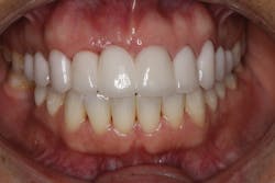 Figure 13: Final bridge insertion after pontic site development. Photo courtesy of Michael J. Wei, DDS, FIADFE. Figure 13: Final bridge insertion after pontic site development. Photo courtesy of Michael J. Wei, DDS, FIADFE.