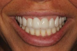 Figure 14: Final picture of smile