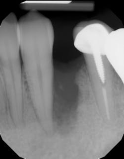 Figure 15: Radiograph of severe bone defect after tooth extraction with bone loss affecting adjacent teeth Figure 15: Radiograph of severe bone defect after tooth extraction with bone loss affecting adjacent teeth