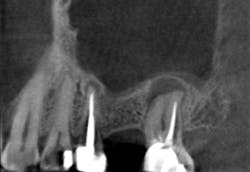 Figure 18: Image of tooth with large infection that will require bone graft after extraction to keep sinus intact and from pneumatizing