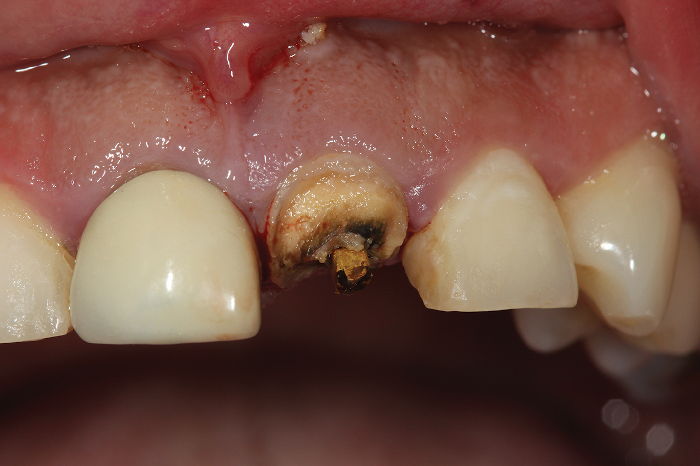 Bone grafting after tooth removal Why, when, and what to use Dental