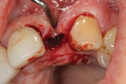 Figure 23: Type 2 socket after tooth extraction, showing loss of buccal plate Figure 23: Type 2 socket after tooth extraction, showing loss of buccal plate