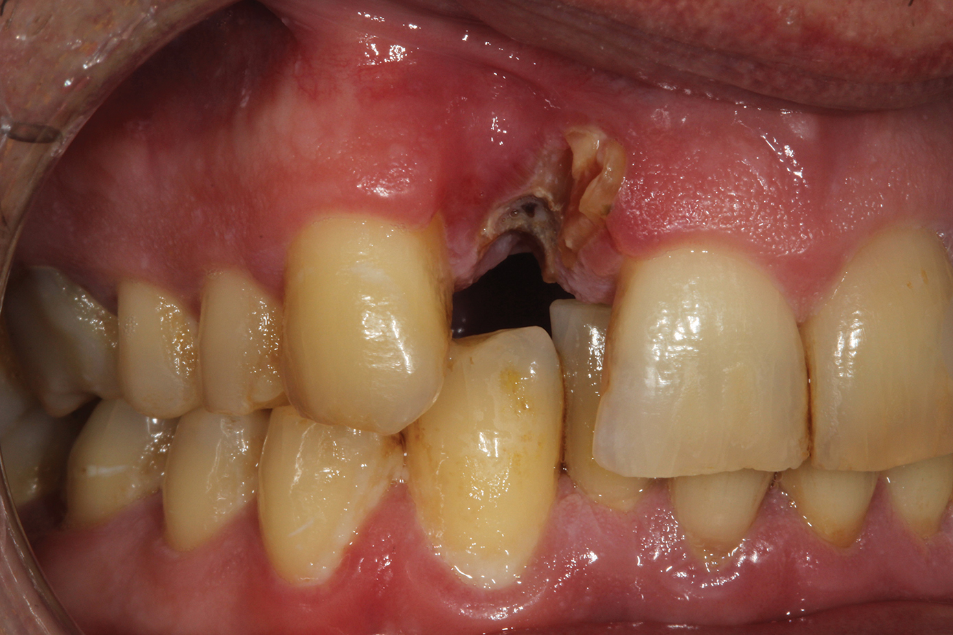 Bone Grafting After Tooth Removal Why When And What To Use Dental   1907DEfro P24.5d3e77ebf0e6a 