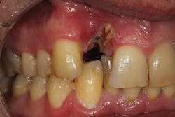 Figure 24: Type 3 socket with buccal plate and soft-tissue loss