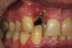 Figure 24: Type 3 socket with buccal plate and soft-tissue loss Figure 24: Type 3 socket with buccal plate and soft-tissue loss