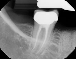 Figure 25: Radiograph of site No. 30, 12 months after bone graft Figure 25: Radiograph of site No. 30, 12 months after bone graft