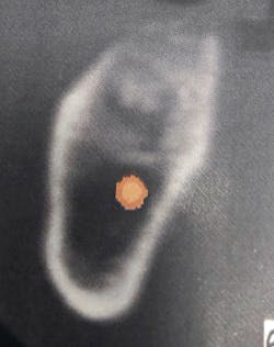 Figure 26: CT scan of bone graft showing poor graft healing and fibrous encapsulation Figure 26: CT scan of bone graft showing poor graft healing and fibrous encapsulation