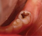 Figure 1: A preoperative photograph of occlusal caries in a left mandibular primary second molar