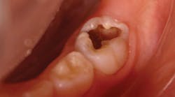 Figure 1: A preoperative photograph of occlusal caries in a left mandibular primary second molar