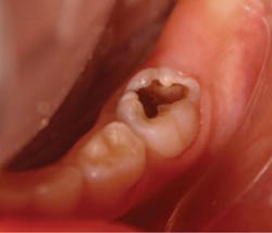 Figure 1: A preoperative photograph of occlusal caries in a left mandibular primary second molar Figure 1: A preoperative photograph of occlusal caries in a left mandibular primary second molar