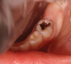 Figure 2: A postoperative photograph following SDF application Figure 2: A postoperative photograph following SDF application