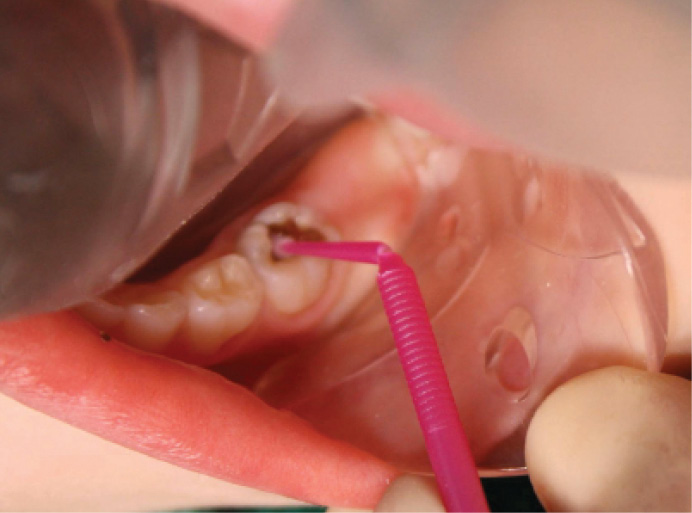 Figure 4: Application of SDF with a micro sponge brush