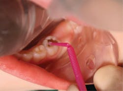 Figure 4: Application of SDF with a micro sponge brush Figure 4: Application of SDF with a micro sponge brush