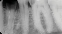 Figure 1: A patient presented with tooth No. 21 fractured at the gumline. The tooth was traumatically extracted and walls were inspected for any bony defects.
