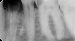 Figure 1: A patient presented with tooth No. 21 fractured at the gumline. The tooth was traumatically extracted and walls were inspected for any bony defects.