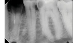 Figure 1: A patient presented with tooth No. 21 fractured at the gumline. The tooth was traumatically extracted and walls were inspected for any bony defects.