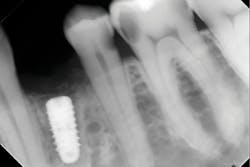 Figure 2: After minimal drill preparation, a MorsTorq 4.1 mm&ndash;diameter by 10 mm&ndash;long implant was inserted until about 1.5 mm subcrestal. The sharp threading engaged into the Type I walls, which created substantial primary stability.