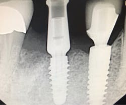 Figure 3: This radiograph is a good side-by-side comparison of a MorsTorq (left) compared to another leading brand (right). Note the very sharp, wide, engaging threads of the MorsTorq, which allow for optimal immediate or conventional placement with a simplified drilling protocol.