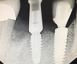 Figure 3: This radiograph is a good side-by-side comparison of a MorsTorq (left) compared to another leading brand (right). Note the very sharp, wide, engaging threads of the MorsTorq, which allow for optimal immediate or conventional placement with a simplified drilling protocol. Figure 3: This radiograph is a good side-by-side comparison of a MorsTorq (left) compared to another leading brand (right). Note the very sharp, wide, engaging threads of the MorsTorq, which allow for optimal immediate or conventional placement with a simplified drilling protocol.