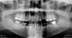 Figure 4: A hopeless full dentition is an ideal opportunity for immediate implants. The patient elected full-arch fixed implants. Figure 4: A hopeless full dentition is an ideal opportunity for immediate implants. The patient elected full-arch fixed implants.