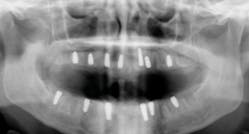 Figure 5: Note the wide, sharp threading that allows for a high degree of initial primary stability, along with ideal 1.5 mm subcrestal placement in immediate sites.