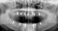 Figure 5: Note the wide, sharp threading that allows for a high degree of initial primary stability, along with ideal 1.5 mm subcrestal placement in immediate sites. Figure 5: Note the wide, sharp threading that allows for a high degree of initial primary stability, along with ideal 1.5 mm subcrestal placement in immediate sites.