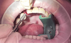Figure 6: Note the self-drilling features created by the full body length flute. This allows for engaging in socket walls with minimal drill preparation (MorsTorq, IH Biomedical). Figure 6: Note the self-drilling features created by the full body length flute. This allows for engaging in socket walls with minimal drill preparation (MorsTorq, IH Biomedical).