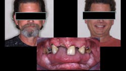 Figure 2: This patient was interviewed by a Dental Lifeline Network social worker and found to be a deserving, responsible, and needy patient who had fallen on hard times. The resultant treatment changed his life! Similarly, donating treatment develops a great feeling of accomplishment for the dentist performing the treatment.