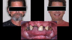 Figure 2: This patient was interviewed by a Dental Lifeline Network social worker and found to be a deserving, responsible, and needy patient who had fallen on hard times. The resultant treatment changed his life! Similarly, donating treatment develops a great feeling of accomplishment for the dentist performing the treatment. Figure 2: This patient was interviewed by a Dental Lifeline Network social worker and found to be a deserving, responsible, and needy patient who had fallen on hard times. The resultant treatment changed his life! Similarly, donating treatment develops a great feeling of accomplishment for the dentist performing the treatment.