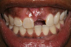 Figure 1: Recently extracted site tooth No. 9 (Photo courtesy of Calvin Bessonet, DDS) Figure 1: Recently extracted site tooth No. 9 (Photo courtesy of Calvin Bessonet, DDS)