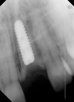 Figure 2: Self-tapping implant placed sub-crestal to maximize esthetics with a morse taper connection (MorsTorq [iH Biomedical])