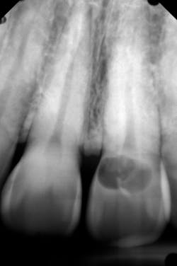 Figure 3: External root resorption of No. 9 necessitating extraction (Calvin Bessonet, DDS) Figure 3: External root resorption of No. 9 necessitating extraction (Calvin Bessonet, DDS)