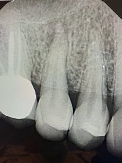 Figure 5: Vertical root fracture on tooth No. 4 requiring extraction (Photo courtesy of David Prince, DDS)