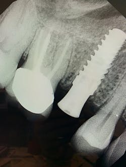 Figure 6: Immediate implant with aggressive, osseo-condensing threading used with a high torque value and primary stability (iHex1 [iH Biomedical])