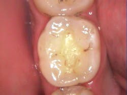 Figure 1: A lower molar following amalgam removal Figure 1: A lower molar following amalgam removal