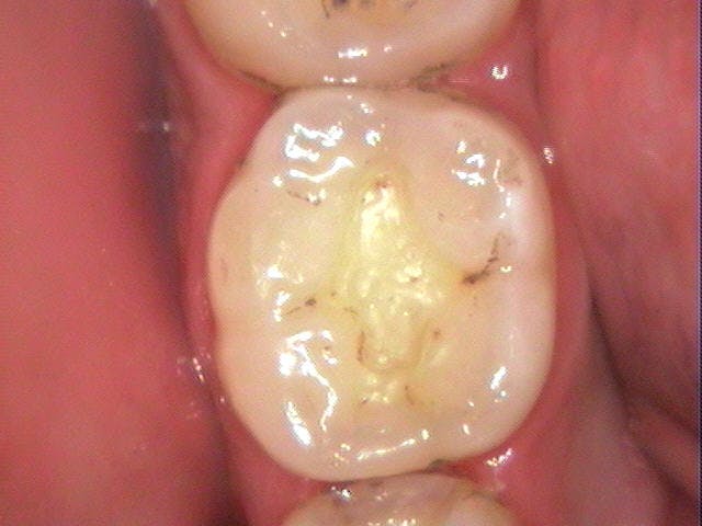 Figure 1: A lower molar following amalgam removal