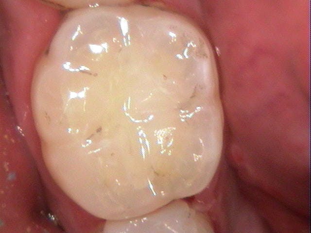 Figure 2: Omnichroma immediately after curing